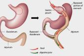 Bariatric Surgery: Cardiometabolic Benefits Down, but Not Out, at 5 Years